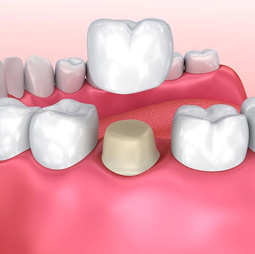 dental crown placement cap