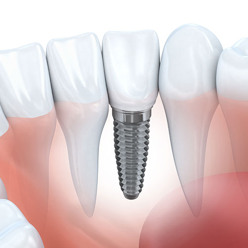 dental implant fitting procedure