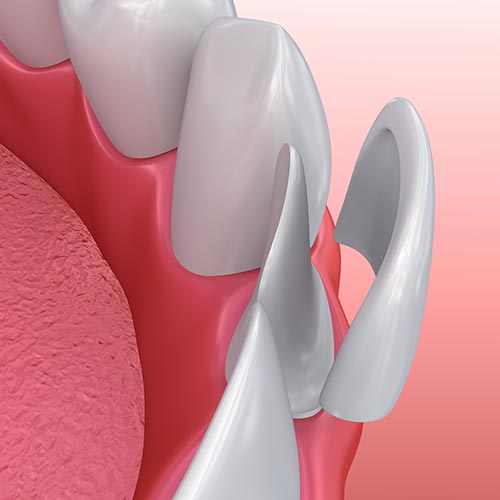 Cosmetic dentist uses dental veneers