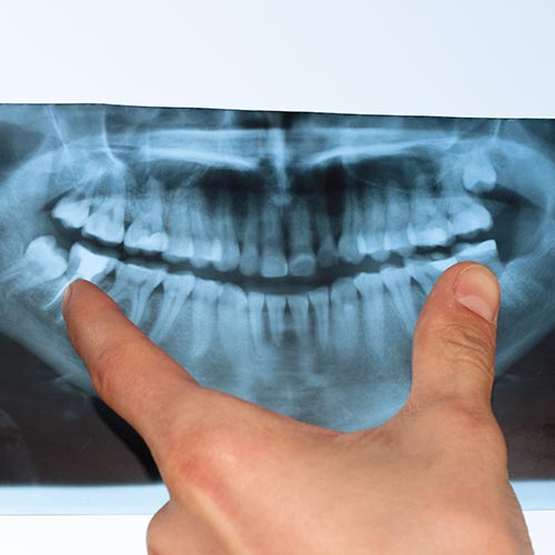 dentist hand touching panoramic x-ray