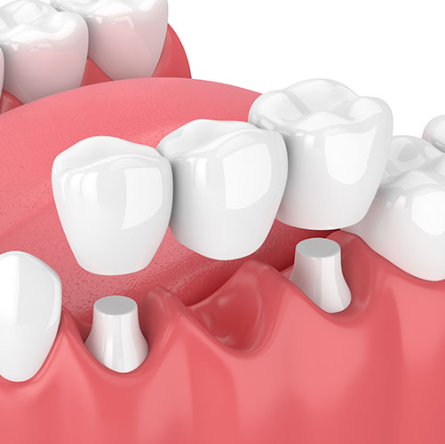 dental bridge procedure in Mississauga shown
